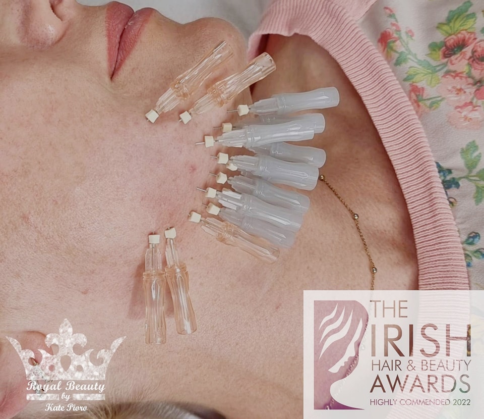 picture face of the lady treated with PDO threads 