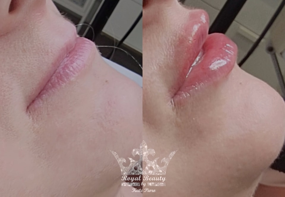 lips before treatment and after treatment